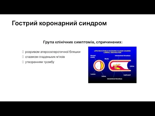 Гострий коронарний синдром Група клінічних симптомів, спричинених: розривом атеросклеротичної бляшки спазмом гладеньких м'язів утворенням тромбу