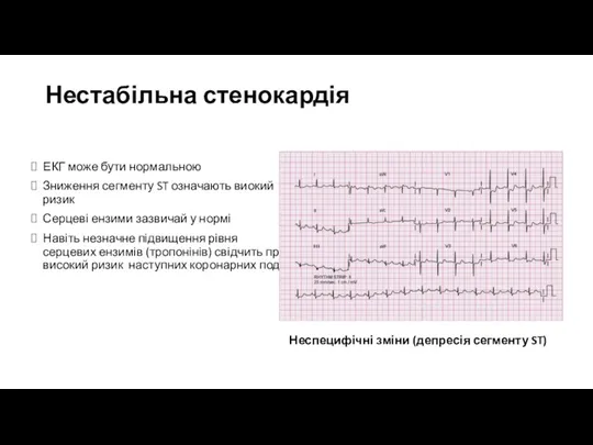 Нестабільна стенокардія ЕКГ може бути нормальною Зниження сегменту ST означають