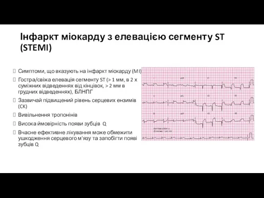 Інфаркт міокарду з елевацією сегменту ST (STEMI) Симптоми, що вказують