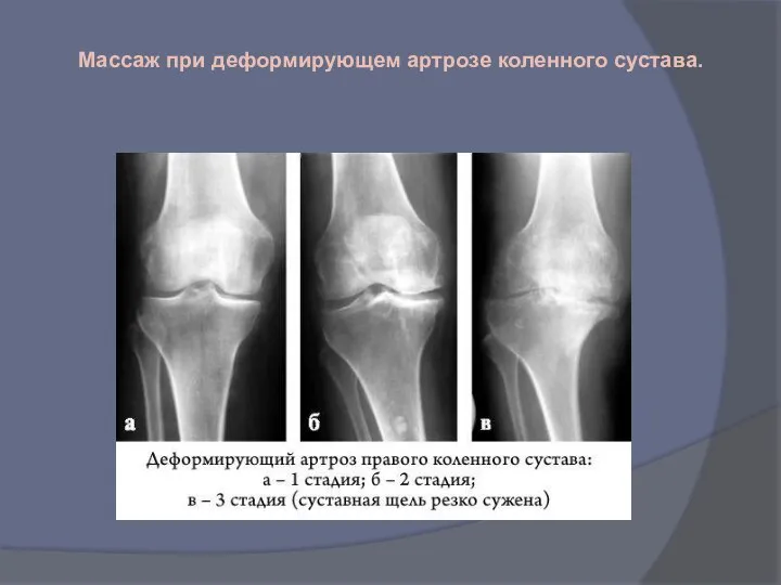 Массаж при деформирующем артрозе коленного сустава.