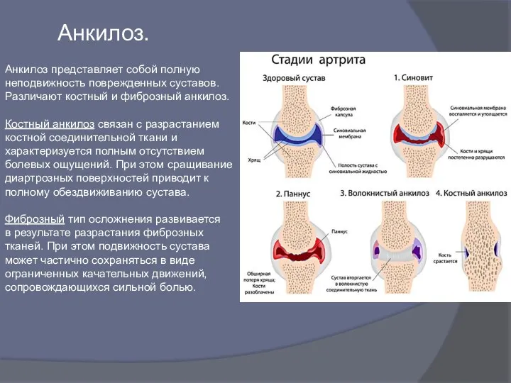 Анкилоз представляет собой полную неподвижность поврежденных суставов. Различают костный и