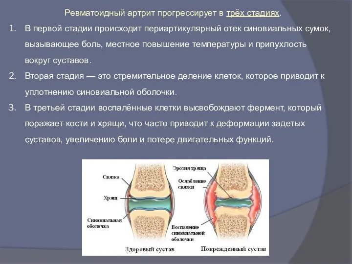 Ревматоидный артрит прогрессирует в трёх стадиях. В первой стадии происходит