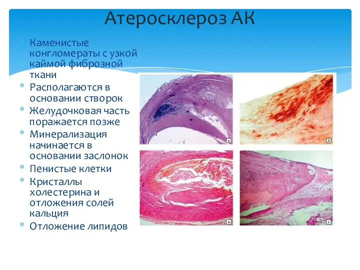 Каменистые конгломераты с узкой каймой фиброзной ткани Располагаются в основании створок Желудочковая часть