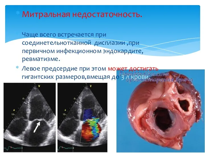 Митральная недостаточность. Чаще всего встречается при соединетельнотканной дисплазии ,при первичном инфекционном эндокардите,ревматизме. Левое