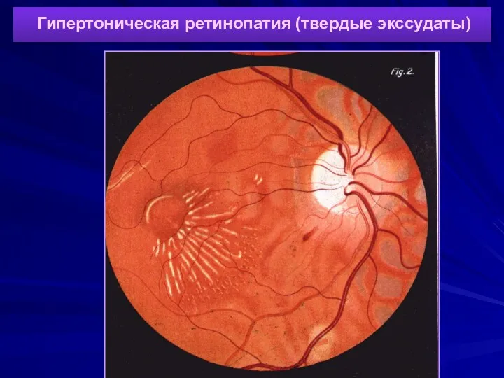 Гипертоническая ретинопатия (твердые экссудаты)