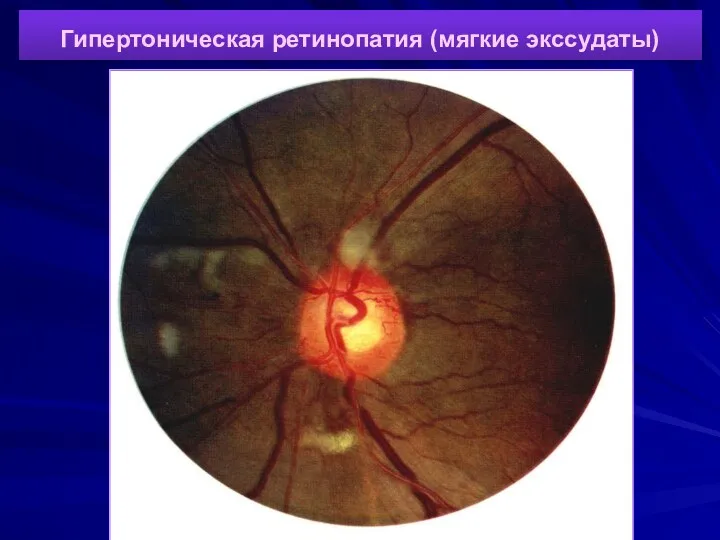 Гипертоническая ретинопатия (мягкие экссудаты)