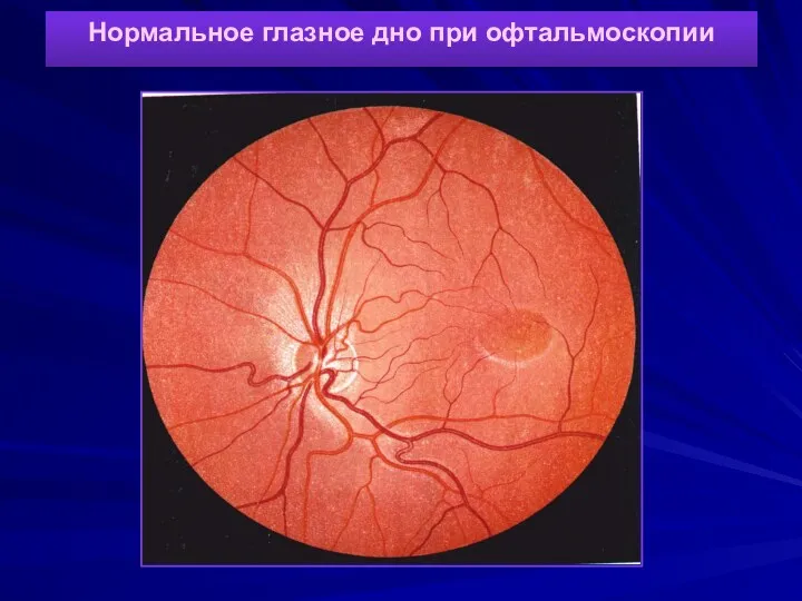 Нормальное глазное дно при офтальмоскопии