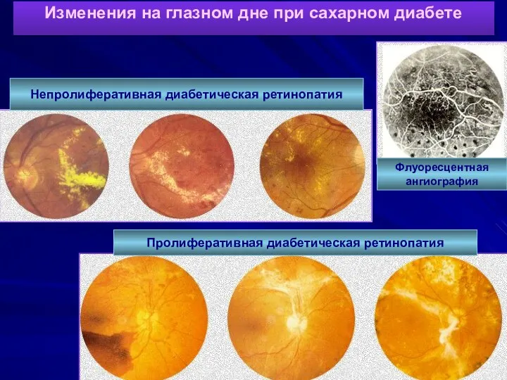 Изменения на глазном дне при сахарном диабете Непролиферативная диабетическая ретинопатия Флуоресцентная ангиография Пролиферативная диабетическая ретинопатия