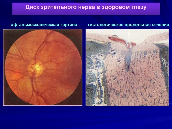 Диск зрительного нерва в здоровом глазу офтальмоскопическая картина гистологическое продольное сечение