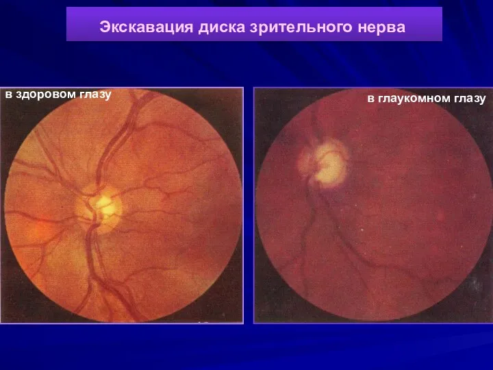 Экскавация диска зрительного нерва в здоровом глазу в глаукомном глазу