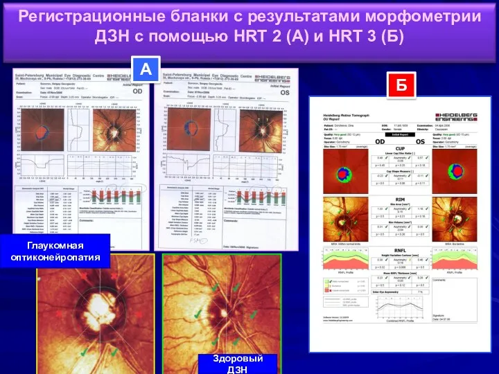Б А Здоровый ДЗН Глаукомная оптиконейропатия