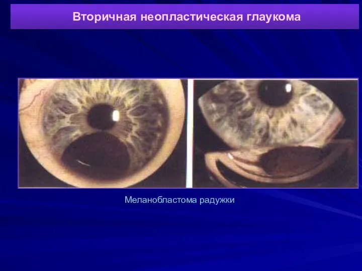 Вторичная неопластическая глаукома Меланобластома радужки