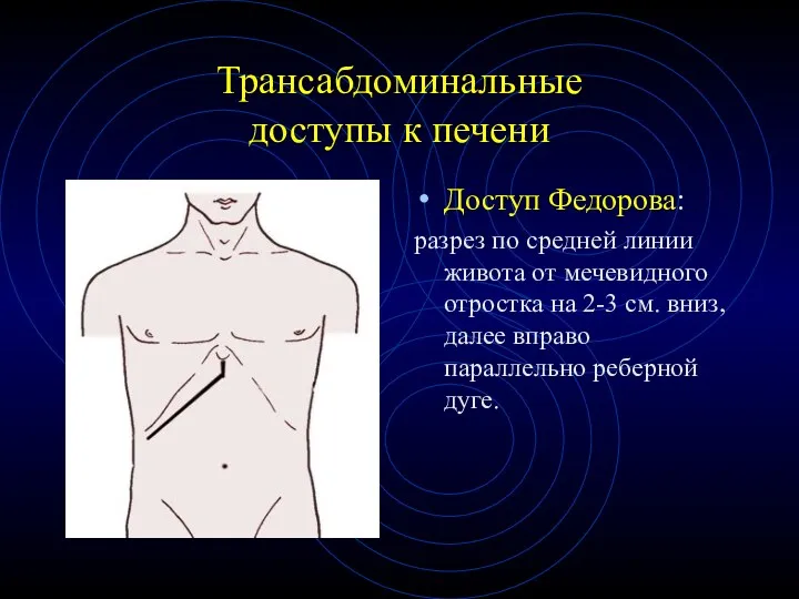 Трансабдоминальные доступы к печени Доступ Федорова: разрез по средней линии