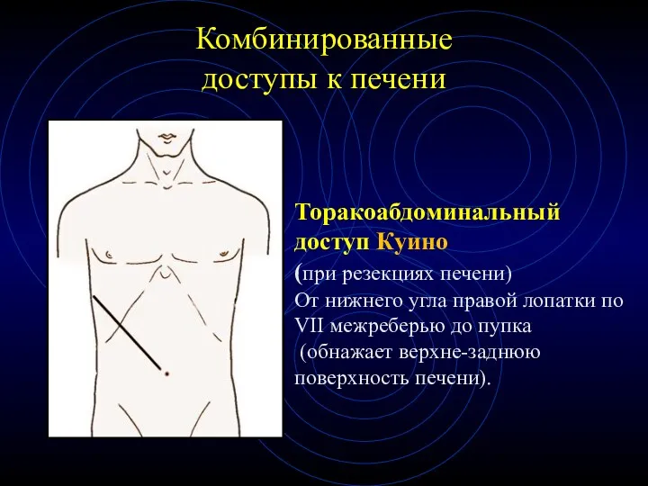 Комбинированные доступы к печени Торакоабдоминальный доступ Куино (при резекциях печени) От нижнего угла