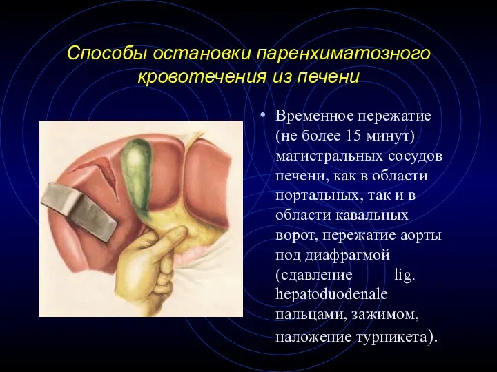 Способы остановки паренхиматозного кровотечения из печени Временное пережатие (не более 15 минут) магистральных