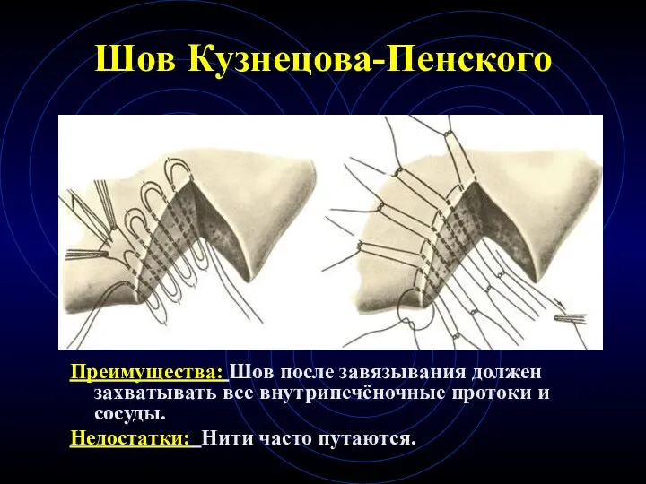 Шов Кузнецова-Пенского Преимущества: Шов после завязывания должен захватывать все внутрипечёночные протоки и сосуды.