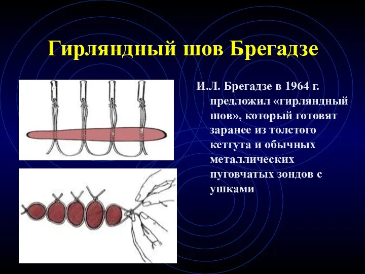 Гирляндный шов Брегадзе И.Л. Брегадзе в 1964 г. предложил «гирляндный шов», который готовят