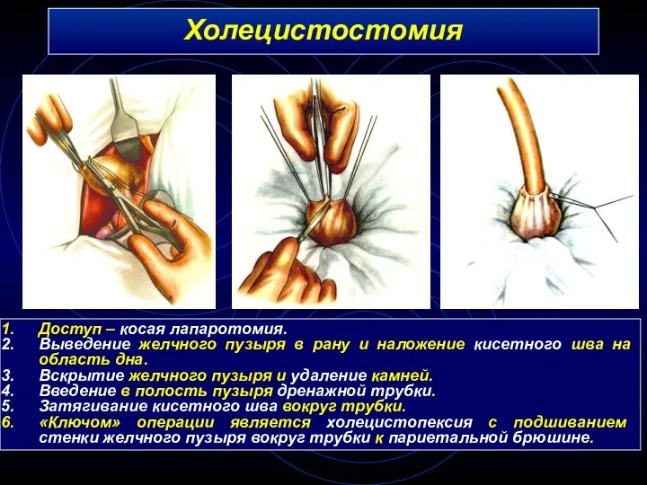 Холецистостомия Доступ – косая лапаротомия. Выведение желчного пузыря в рану и наложение кисетного
