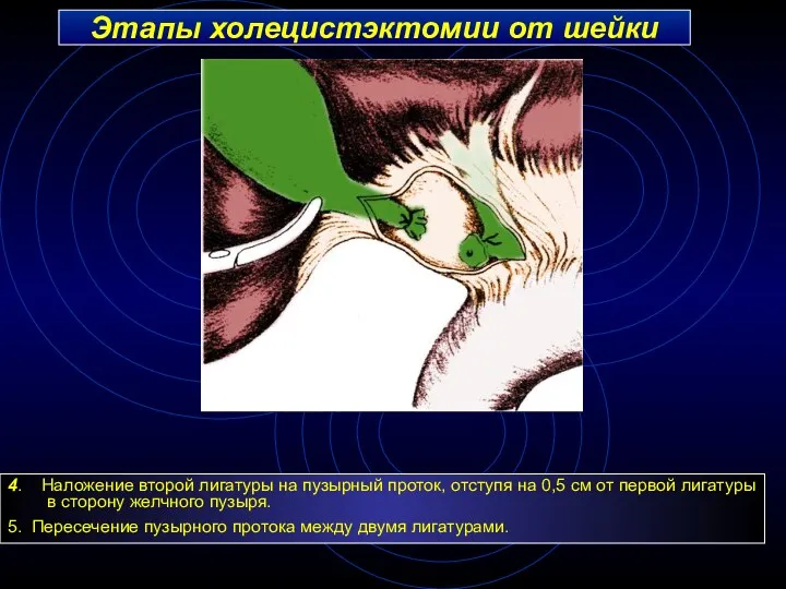 Этапы холецистэктомии от шейки 4. Наложение второй лигатуры на пузырный проток, отступя на