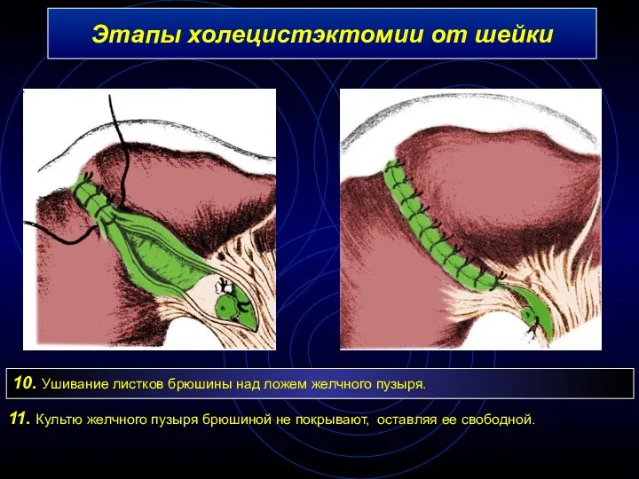 Этапы холецистэктомии от шейки 10. Ушивание листков брюшины над ложем