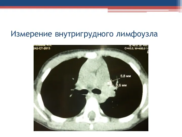 Измерение внутригрудного лимфоузла