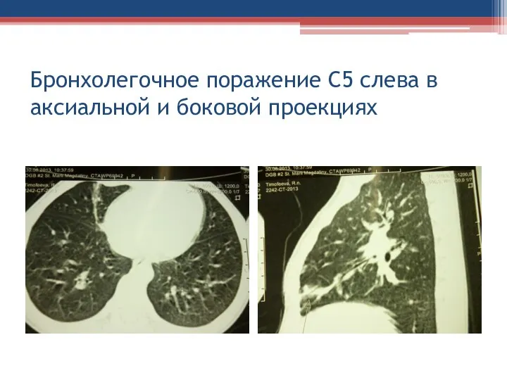 Бронхолегочное поражение С5 слева в аксиальной и боковой проекциях