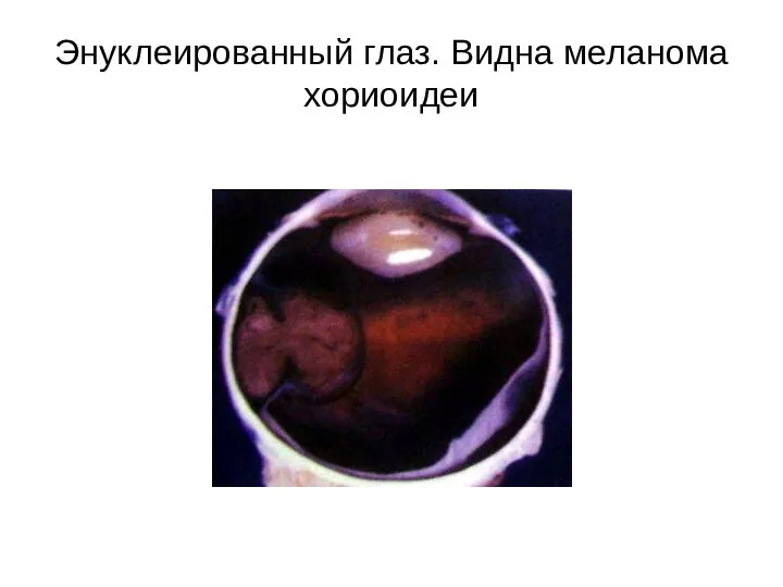 Энуклеированный глаз. Видна меланома хориоидеи