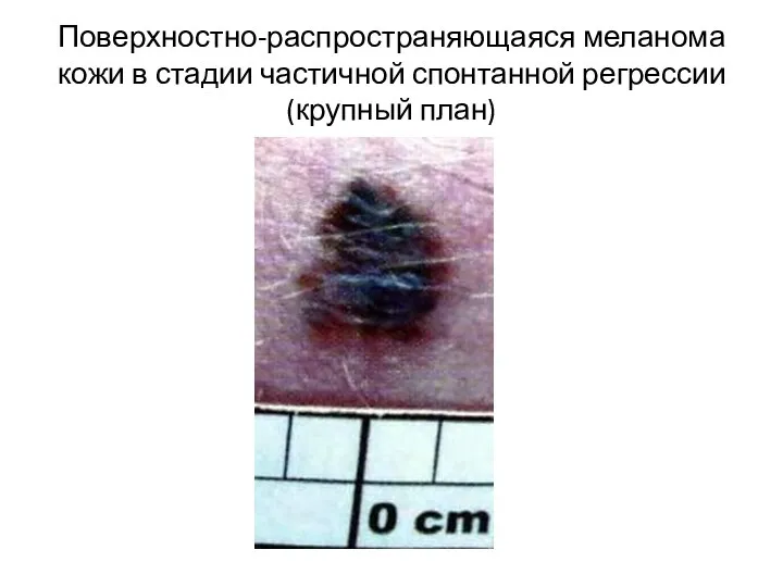 Поверхностно-распространяющаяся меланома кожи в стадии частичной спонтанной регрессии (крупный план)