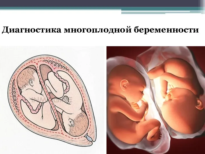 Диагностика многоплодной беременности