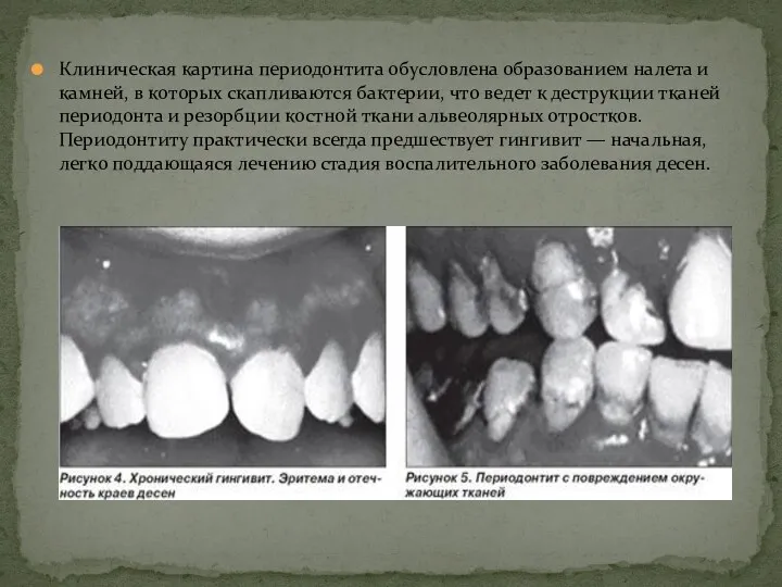 Клиническая картина периодонтита обусловлена образованием налета и камней, в которых