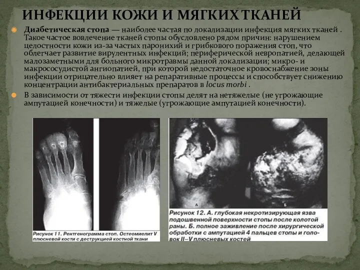 Диабетическая стопа — наиболее частая по локализации инфекция мягких тканей