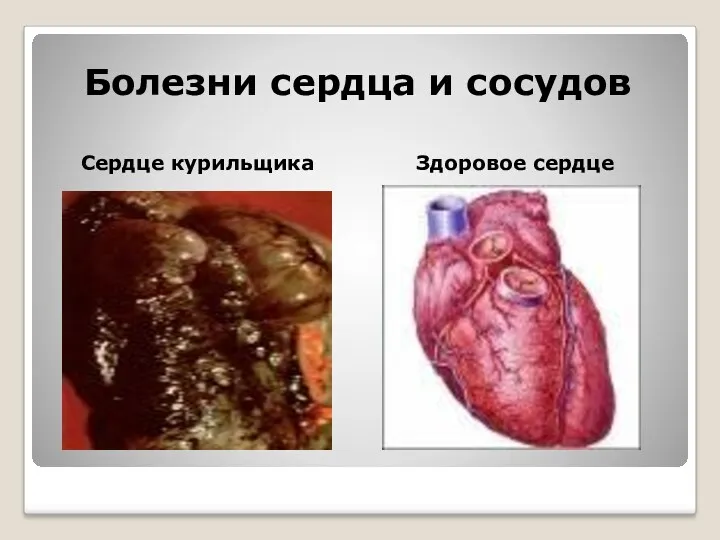 Болезни сердца и сосудов Сердце курильщика Здоровое сердце