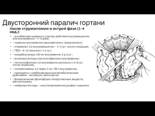 Двусторонний паралич гортани после струмэктомии в острой фазе (1–4 нед.):