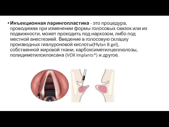 Инъекционная ларингопластика - это процедура, проводимая при изменении формы голосовых связок или их