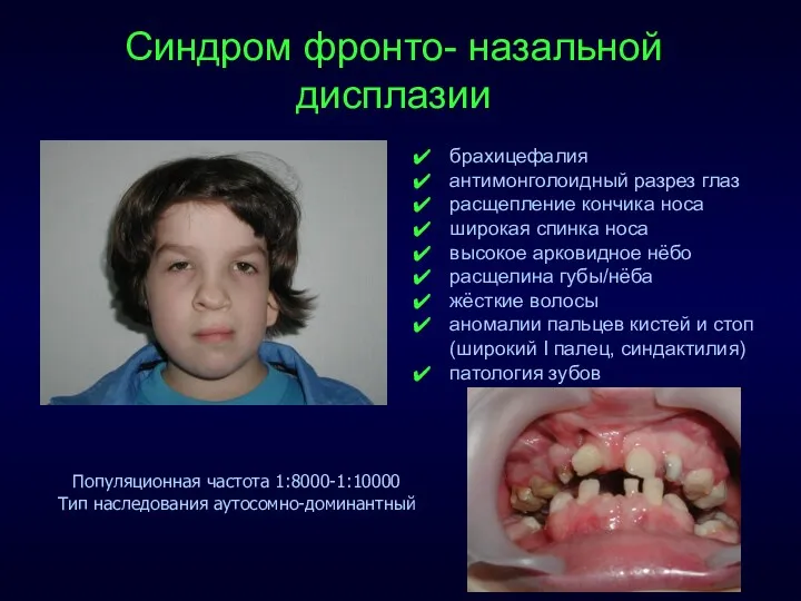 Синдром фронто- назальной дисплазии Популяционная частота 1:8000-1:10000 Тип наследования аутосомно-доминантный