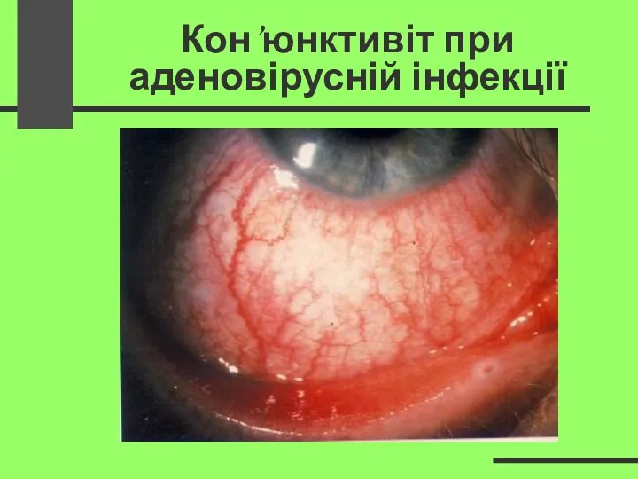 Кон’юнктивіт при аденовірусній інфекції