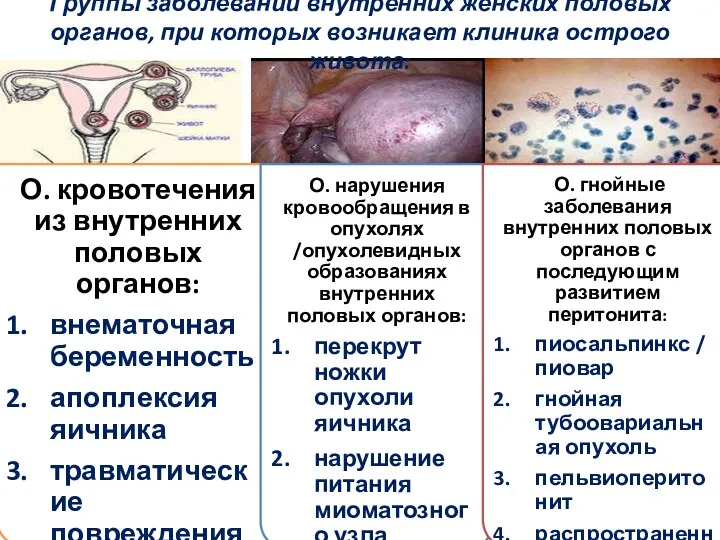 Группы заболеваний внутренних женских половых органов, при которых возникает клиника острого живота: