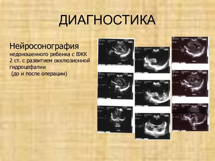 ДИАГНОСТИКА Нейросонография недоношенного ребенка с ВЖК 2 ст. с развитием окклюзионной гидроцефалии (до и после операции)