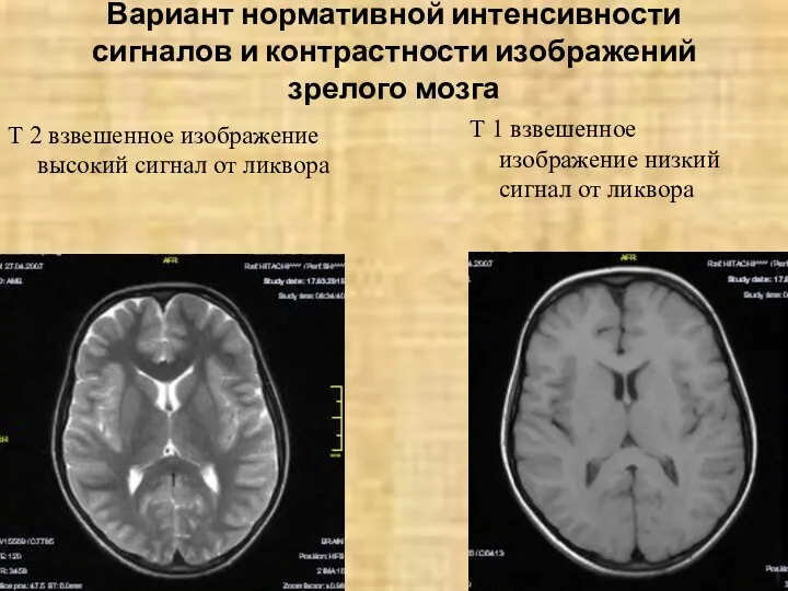 Вариант нормативной интенсивности сигналов и контрастности изображений зрелого мозга Т 2 взвешенное изображение