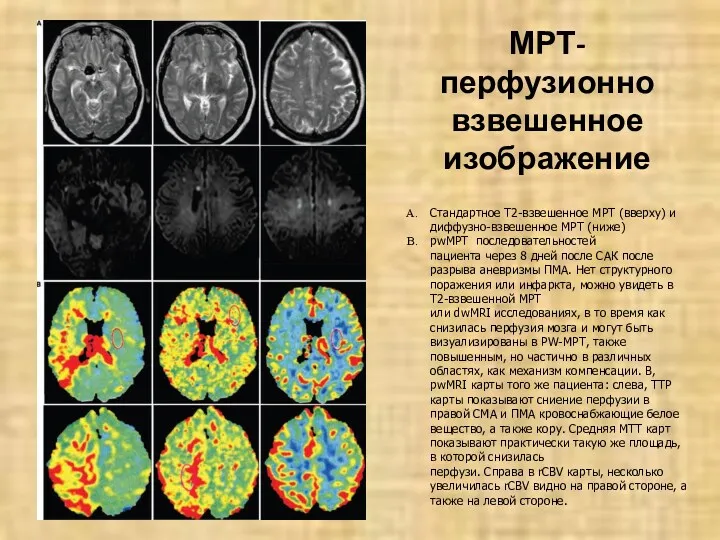 Стандартное T2-взвешенное МРТ (вверху) и диффузно-взвешенное МРТ (ниже) pwМРТ последовательностей пациента через 8