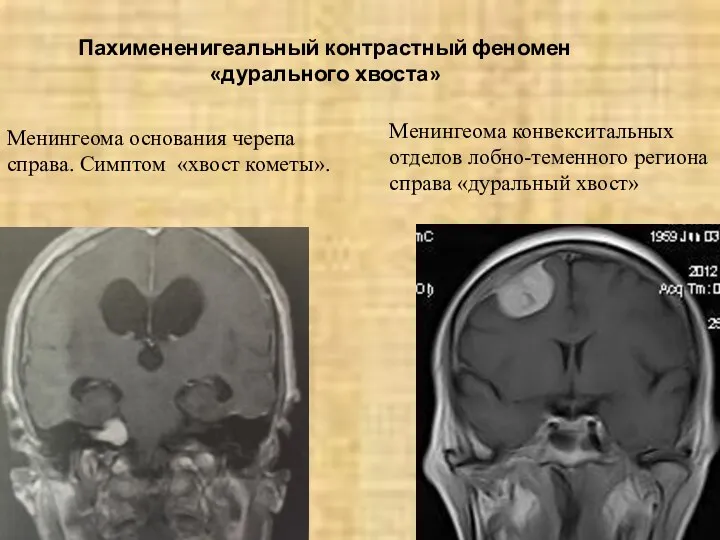 Пахимененигеальный контрастный феномен «дурального хвоста» Менингеома основания черепа справа. Симптом «хвост кометы». Менингеома