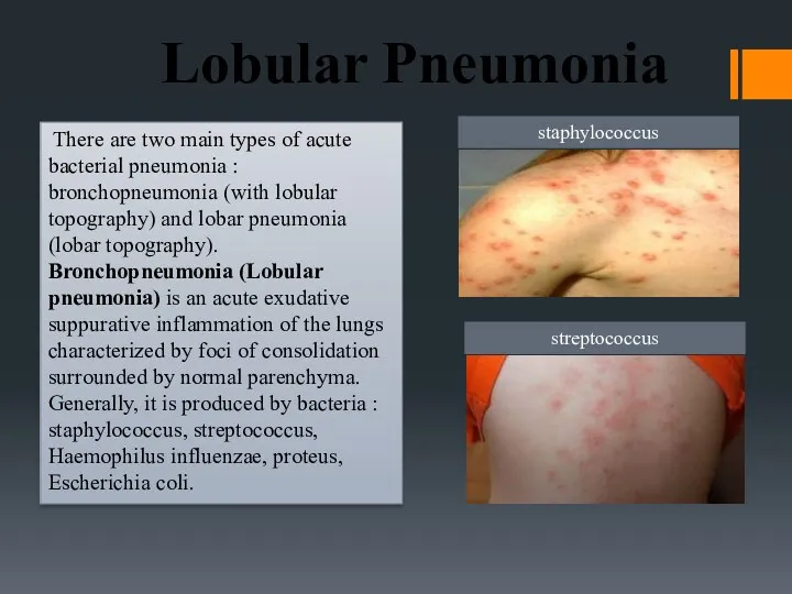 Lobular Pneumonia There are two main types of acute bacterial