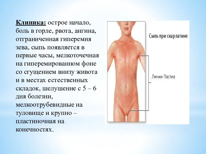 Клиника: острое начало, боль в горле, рвота, ангина, отграниченная гиперемия зева, сыпь появляется