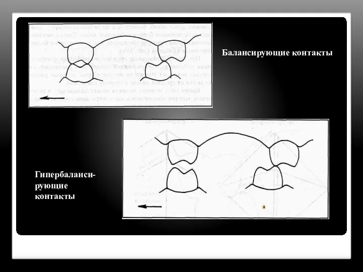 Балансирующие контакты Гипербаланси- рующие контакты