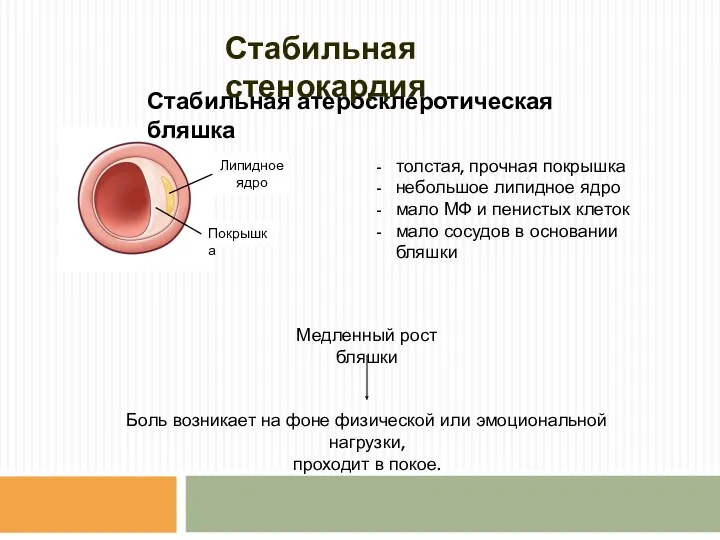 Стабильная атеросклеротическая бляшка Покрышка Липидное ядро толстая, прочная покрышка небольшое липидное ядро мало
