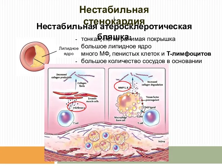 тонкая, легко ранимая покрышка большое липидное ядро много МФ, пенистых клеток и Т-лимфоцитов