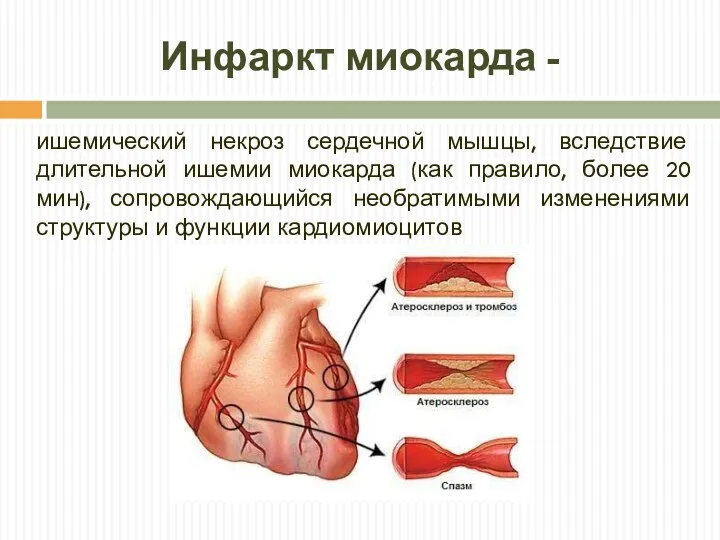 Инфаркт миокарда - ишемический некроз сердечной мышцы, вследствие длительной ишемии