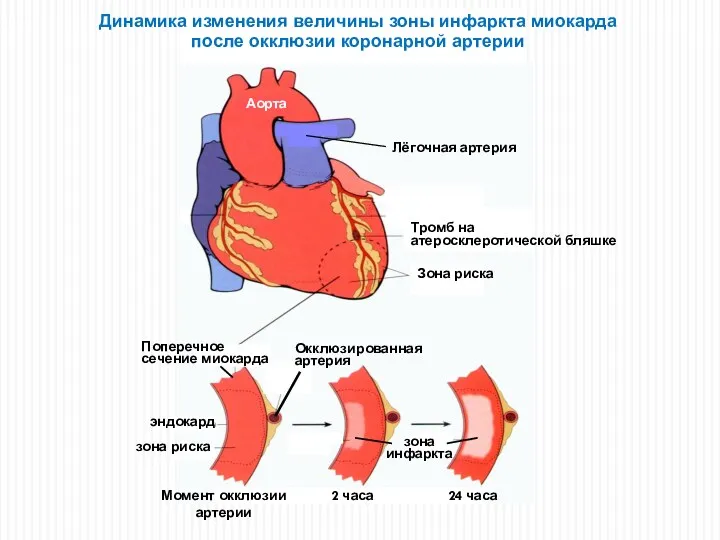 Динамика изменения величины зоны инфаркта миокарда после окклюзии коронарной артерии