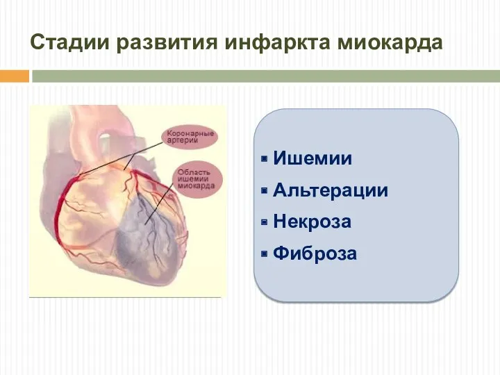 Стадии развития инфаркта миокарда Ишемии Альтерации Некроза Фиброза