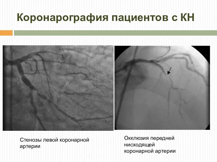 Стенозы левой коронарной артерии Коронарография пациентов с КН Окклюзия передней нисходящей коронарной артерии